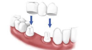 dental crowns humble texas dentistry