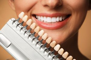 dental veneers near me