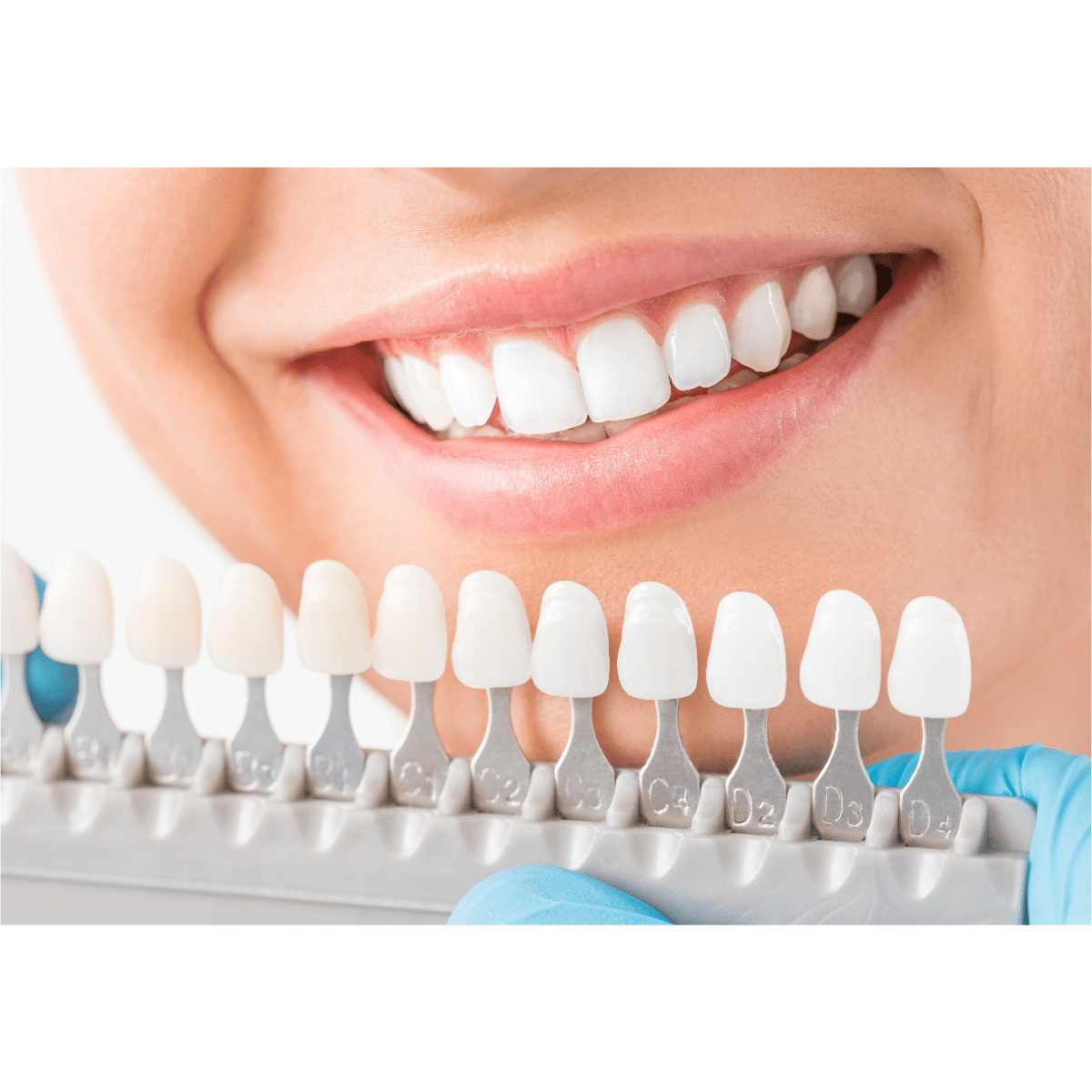 dental veneers humble